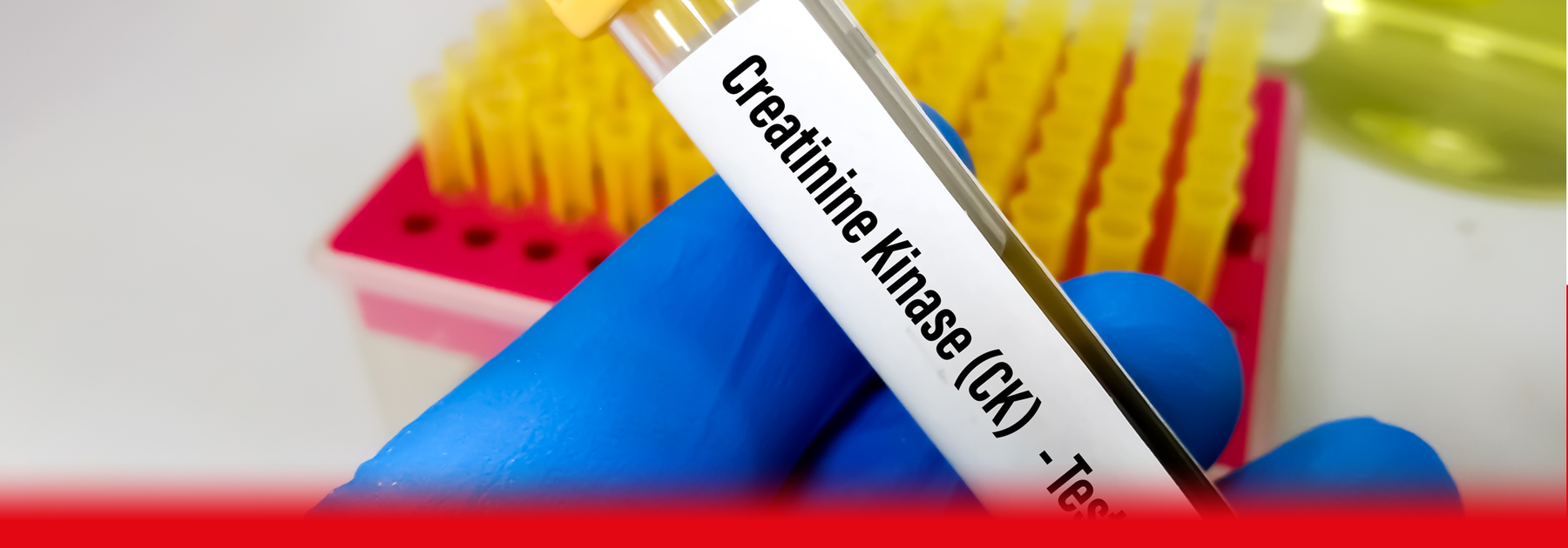 doctor holding creatine kinase blood sample