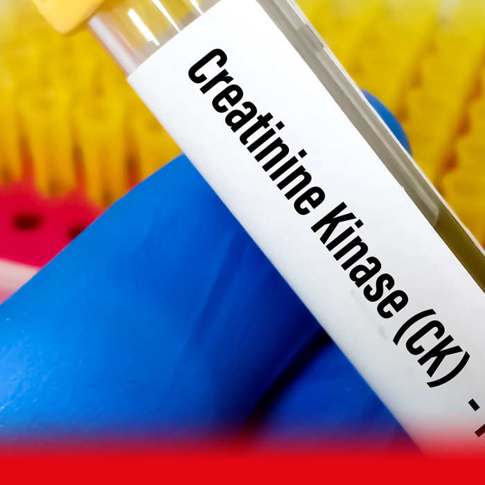 doctor holding creatine kinase blood sample