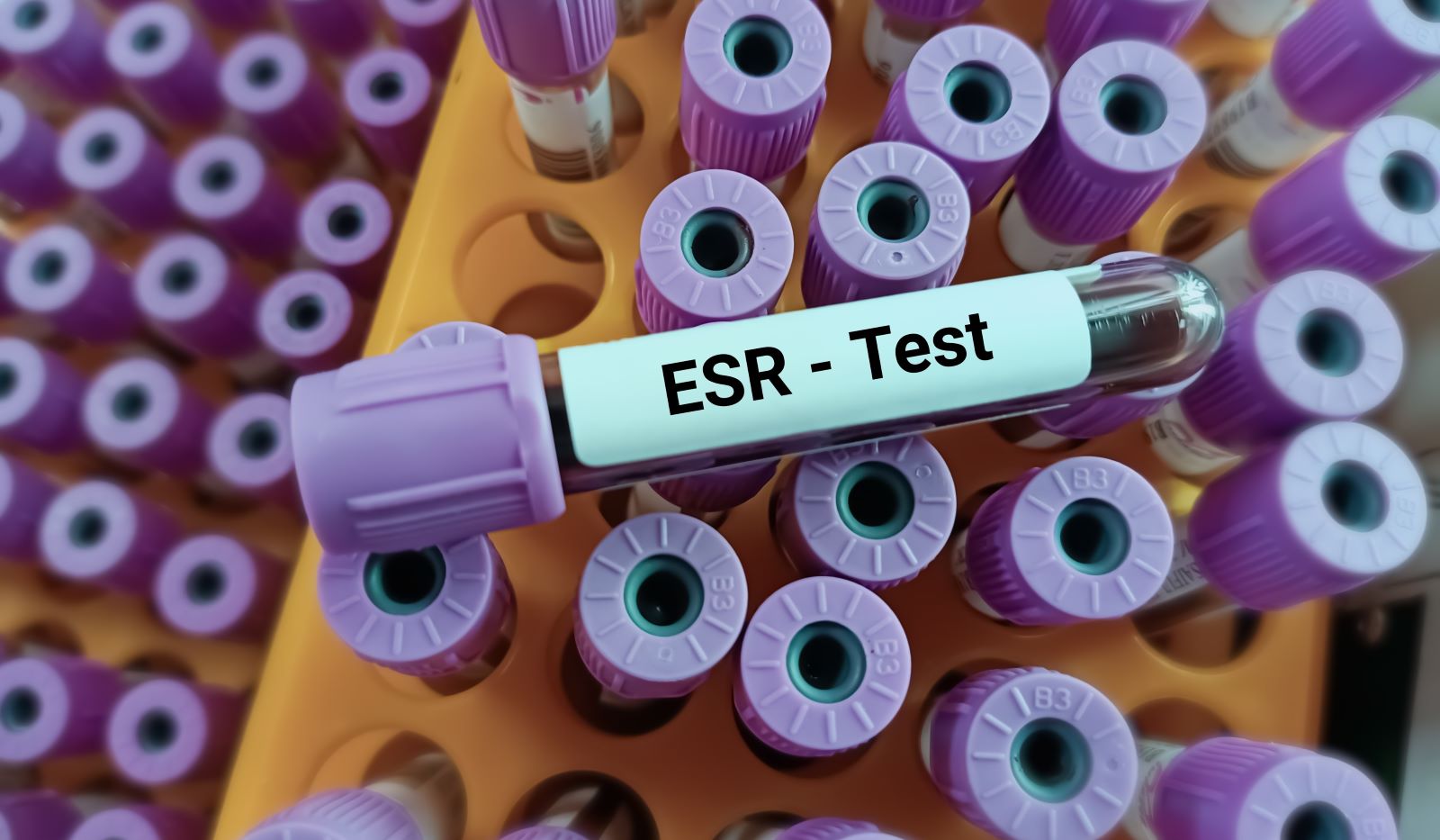 ESR blood test