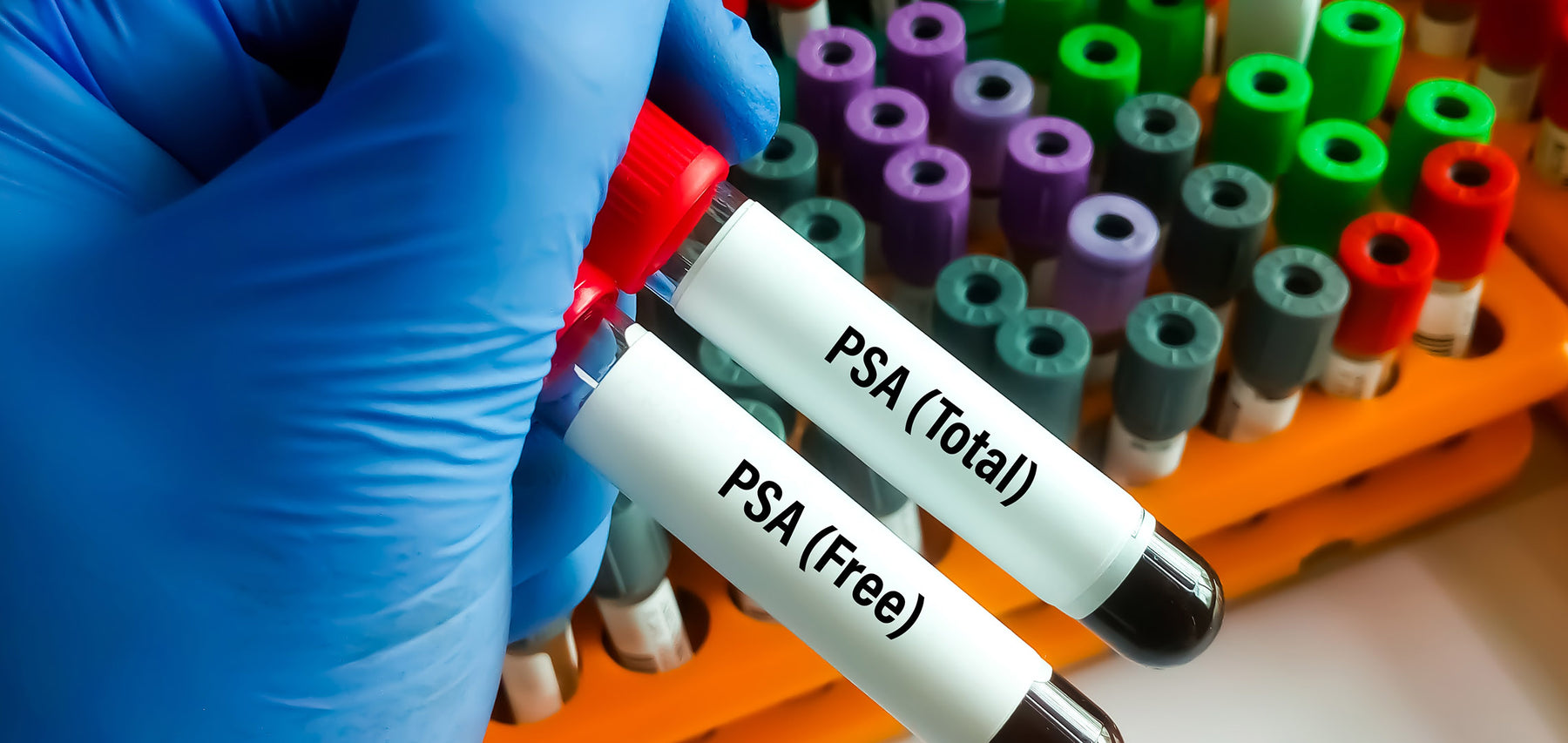 The PSA Blood Test and Prostate Cancer Screening