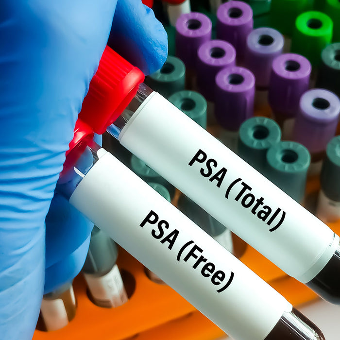 The PSA Blood Test and Prostate Cancer Screening