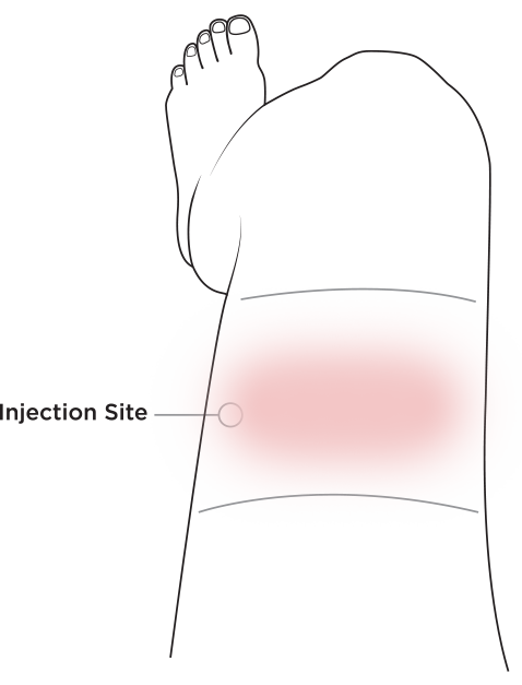 IDENTIFY THE INJECTION SITE