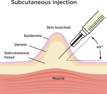 Sc Injection Area Subcutaneous (SC) Self-Injection Instructions — onedaytests.com